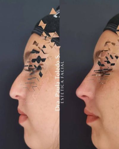 Resultado: Rinomodelación con ácido hialurónico