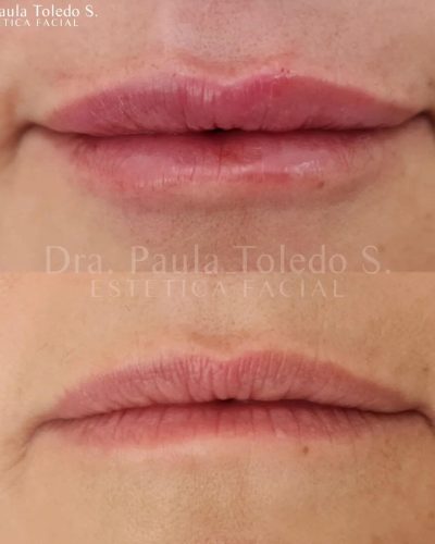 Resultados de elevación de las comisuras en labios