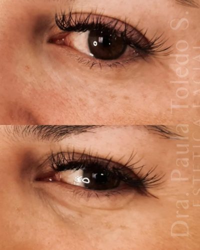 Relleno del valle de lágrimas en paciente