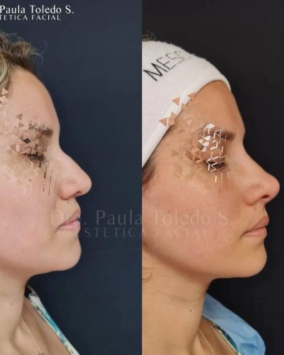 Rinomodelación, simplemente Mina, mina, mina…