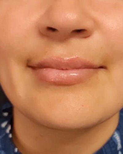 Resultado del antes y después: perfilado y relleno