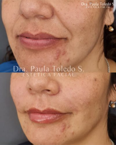 ¿Que es el acido Hialuronico?