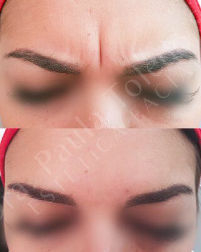 ¿Cuanto tiempo me va a durar el Botox?